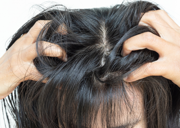 Can Adults Get Head Lice? The Truth About Lice in Grown-Ups